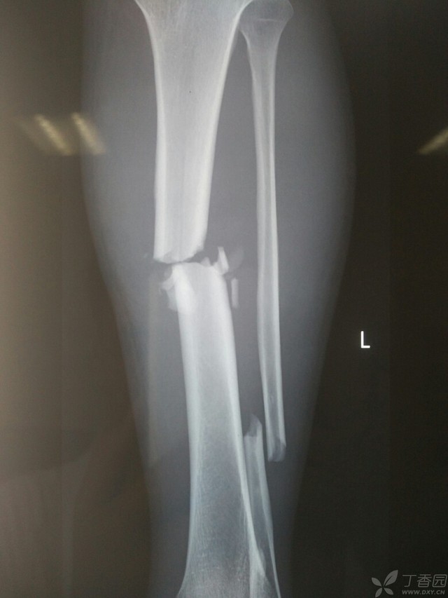 科技重塑脛腓骨骨折康復(fù)之旅，引領(lǐng)未來(lái)體驗(yàn)新篇章