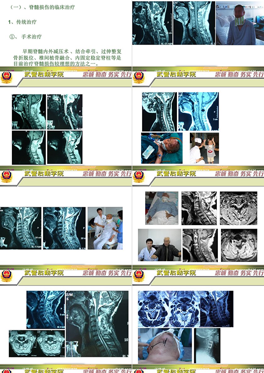 2023年脊髓損傷研究新進展，里程碑式的突破與日常奇妙變化