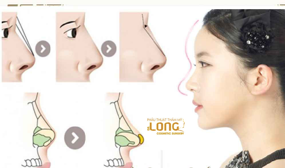 最新鼻整形技術(shù)重塑自信，煥發(fā)新生之美